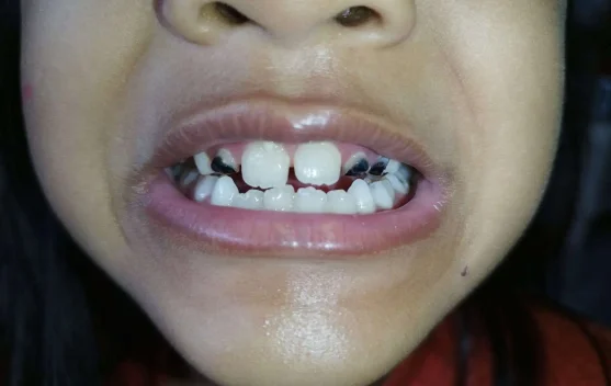 Ketahui Penyebab Karies Gigi Pada Anak Serta Penanganannya