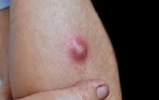 Kenali Penyebabnya Penyakit Bisul