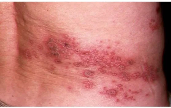 Cacar Api Bisa Menyiksa Bertahun, Sakitnya Lebihi Operasi