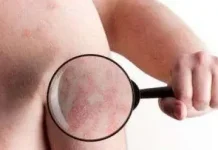 Peringatan Hari Kusta Sedunia Serukan Akhiri Stigma