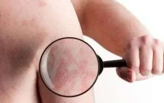 Peringatan Hari Kusta Sedunia Serukan Akhiri Stigma