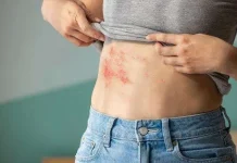 Cacar Api Dapat Menyerang Siapa Saja, Kenali Pencegahannya