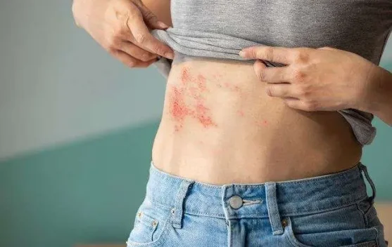 Cacar Api Dapat Menyerang Siapa Saja, Kenali Pencegahannya